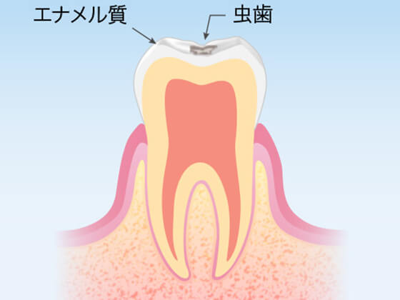 岡山市北区・筒井歯科クリニック・むし歯治療