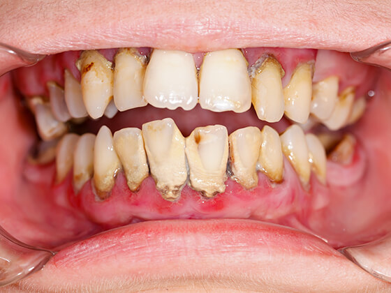 歯周病が進行すると歯を支える顎の骨を溶かす