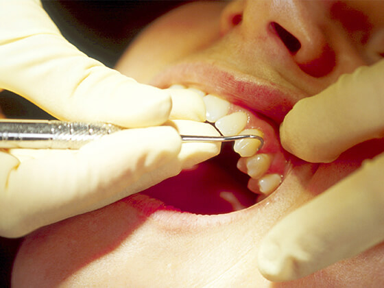 歯垢・歯石の除去