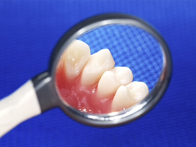 歯周病に関する診療案内